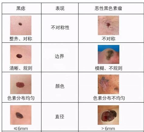 大黑痣|这样的黑痣竟是“黑色素瘤”！医生：超过这个尺寸的黑。